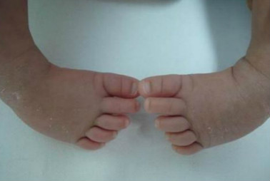 婴幼儿马蹄足的预防和保健.jpg