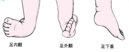 马蹄足症状的四大表现形式.png 马蹄足症状的四大表现形式.png