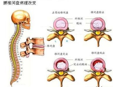腰椎间盘病理改变