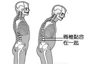 强直性脊柱炎的原因是什么