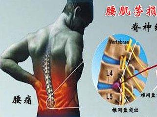 腰肌劳损症状.jpg 腰肌劳损症状.jpg