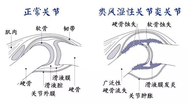 类风湿性关节炎有哪些症状.jpg 类风湿性关节炎有哪些症状.jpg