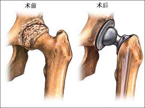 类风湿骨头坏死.jpg