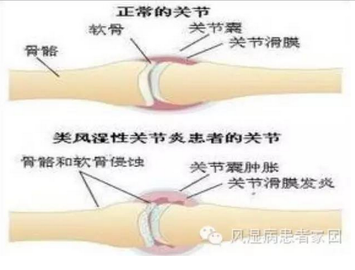 确诊类风湿性关节炎需要做些什么检查.png