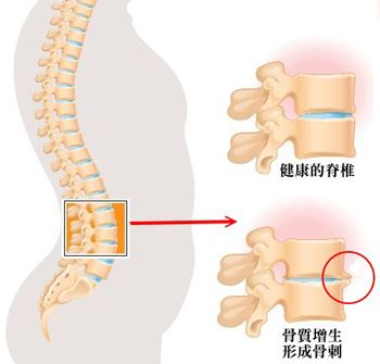 腰椎骨质增生的症状.jpg