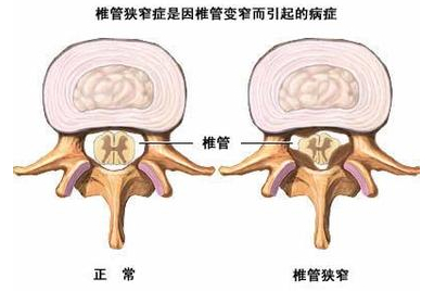 腰椎管侧隐窝狭窄症.jpg