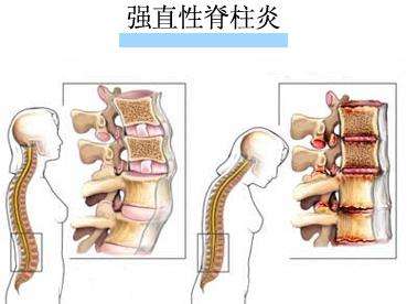 强直性脊柱炎病因.jpg