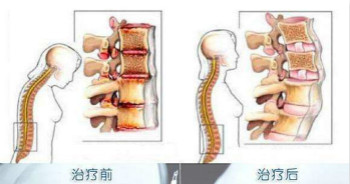 治疗强直性脊柱炎.jpg