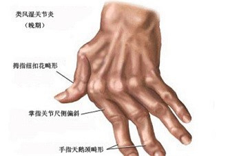 类风湿.jpg 类风湿.jpg