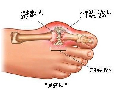 痛风早期的发作症状.jpg