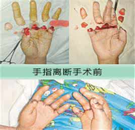 断指分类.jpg