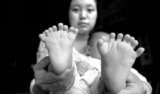 手足畸形5.jpg 手足畸形5.jpg