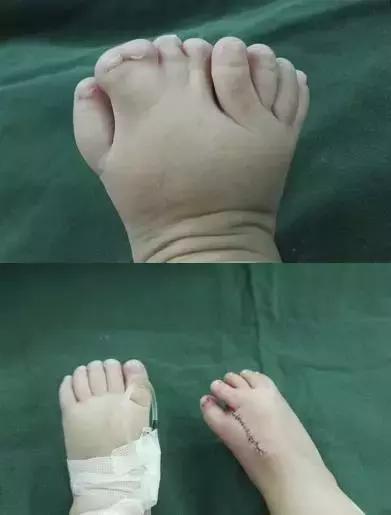 手足畸形1.jpg 手足畸形1.jpg