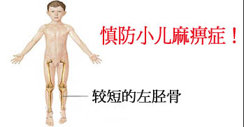 小儿麻痹 小儿麻痹