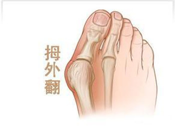 拇外翻原因.jpg 拇外翻原因.jpg