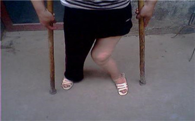 小儿麻痹79.jpg 小儿麻痹79.jpg