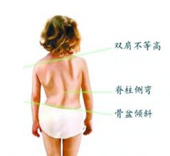 脊柱侧弯缘于不良坐姿.jpg 脊柱侧弯缘于不良坐姿.jpg