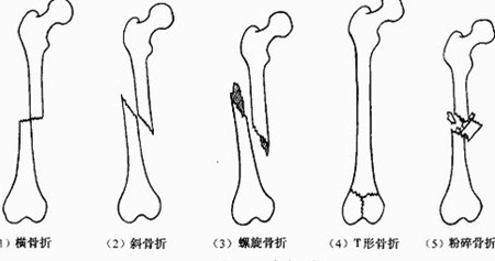 小腿骨折.jpg 小腿骨折.jpg