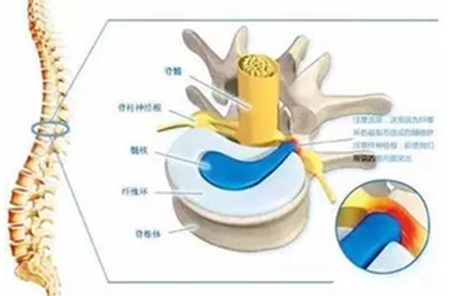 脊髓型颈椎病.png