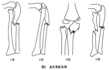 孟氏骨折_副本.jpg