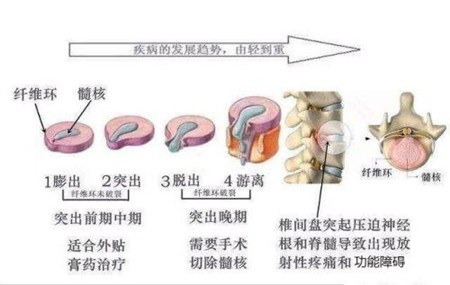 腰椎突出与膨出.jpg