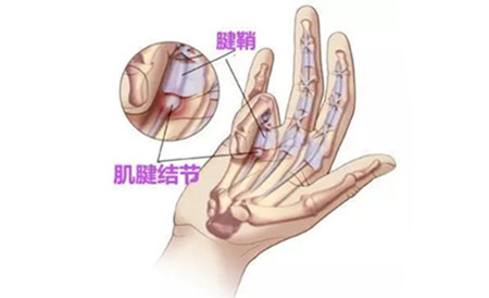 大拇指腱鞘炎.jpg