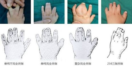 小儿并指畸形1.jpg