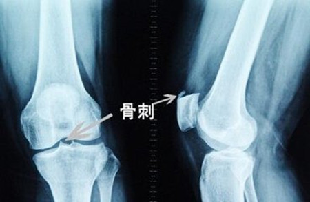 膝关节骨质增生.jpg
