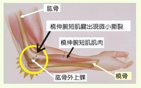 网球肘111.jpg