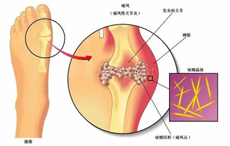 痛风的原因及治疗、.jpg