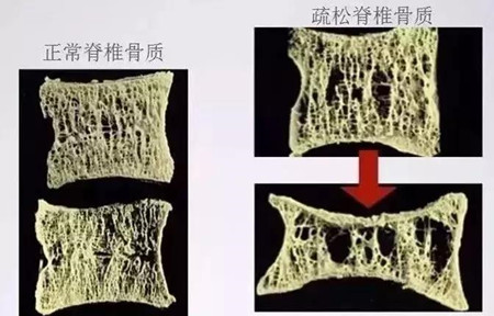 骨质疏松.jpg